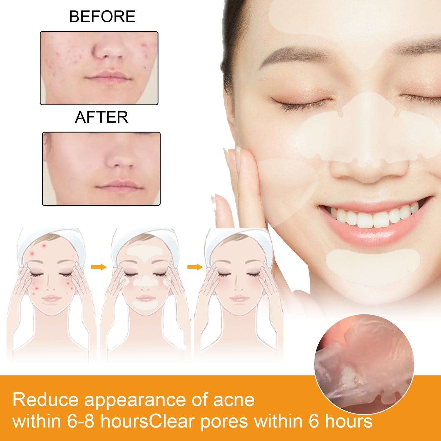 EELHOE Hydrogel Facial Acne Patch