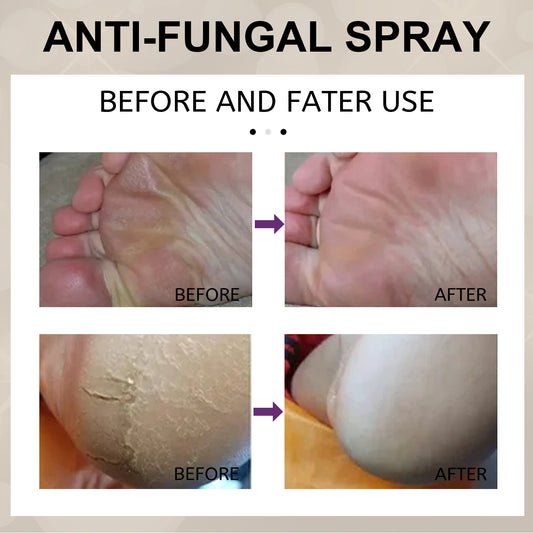 Foot Anti-Fungal Spray